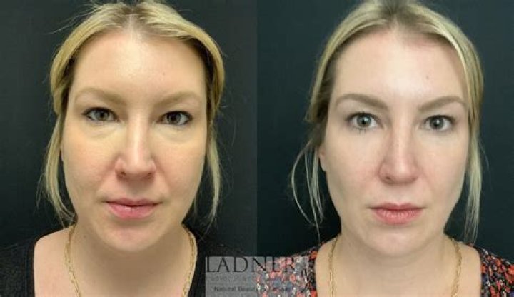 Did Blue Bloods Actor Andy Karl Plastic Surgery? Before and After Photos